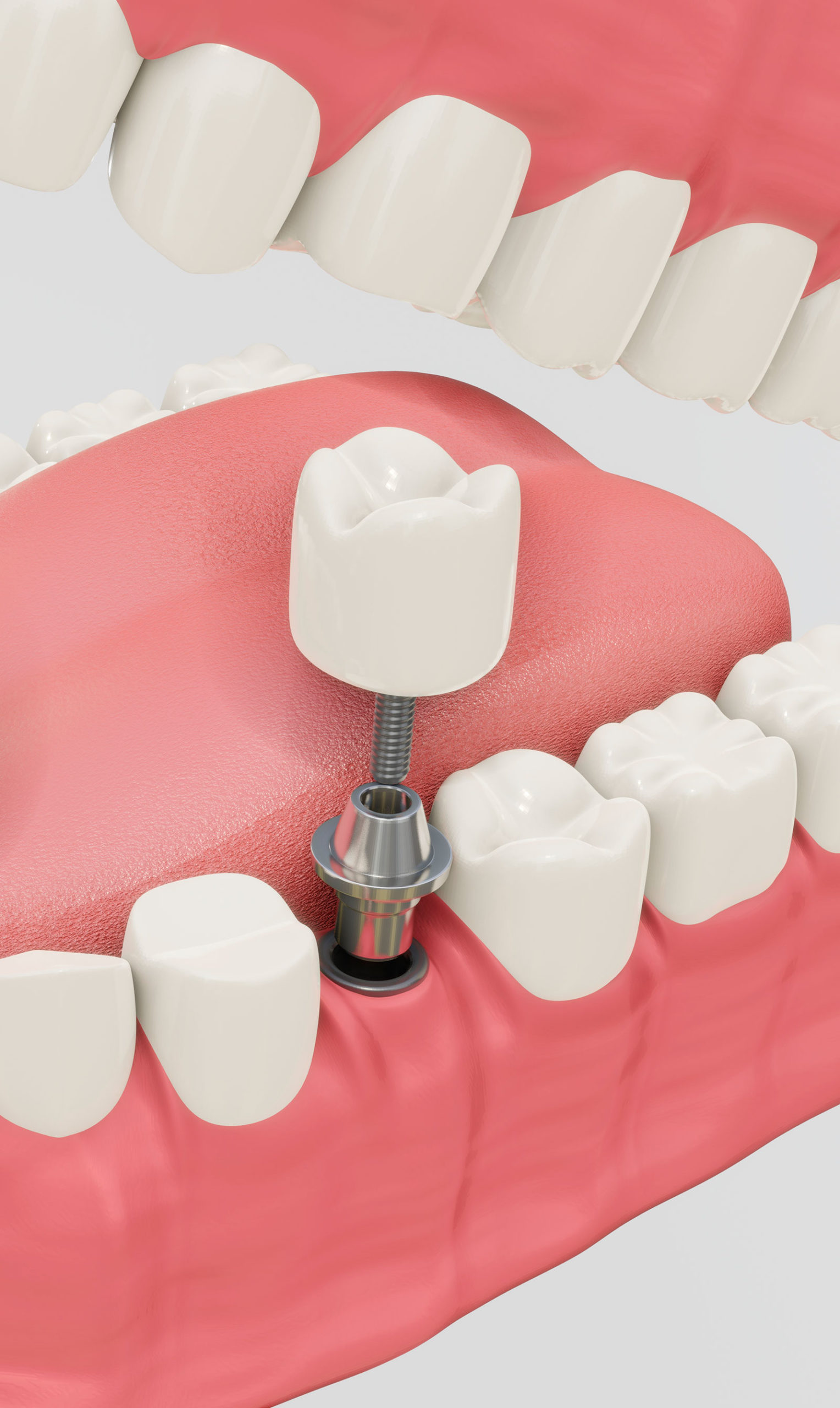 implantes dentales