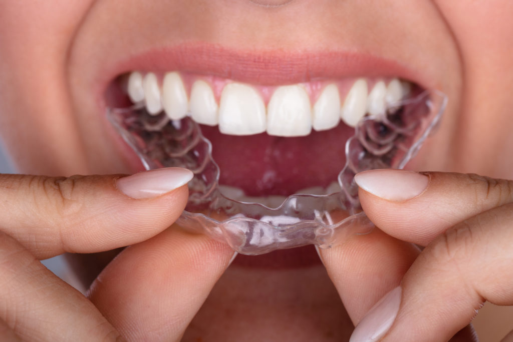 Ortodoncia Invisible: ¿cómo ayuda a tu sonrisa?